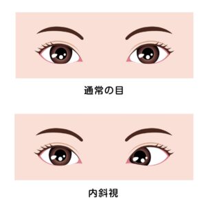 内斜視の画像